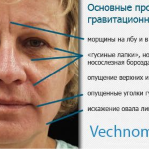 Гравитационный птоз
