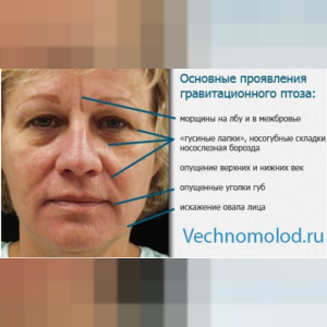Гравитационный птоз
