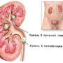 Профилактика мочекаменной болезни