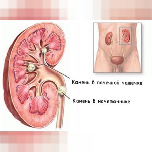 Профилактика мочекаменной болезни